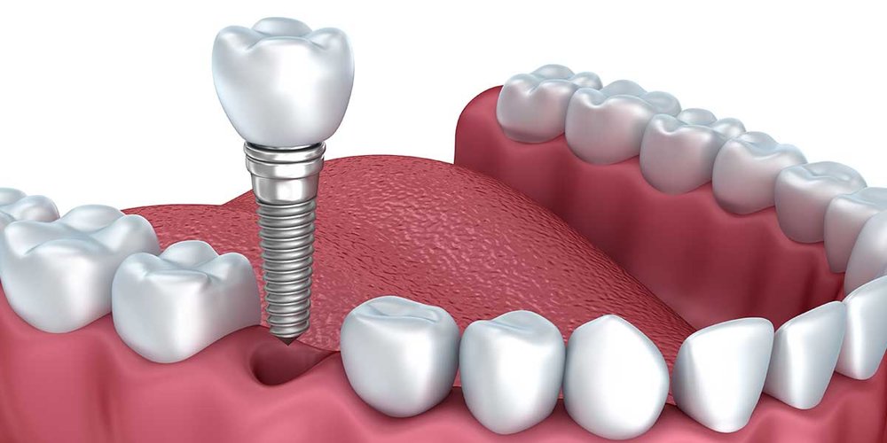 Cheap Dental Implants - Is It Possible To Get Them, And If ...